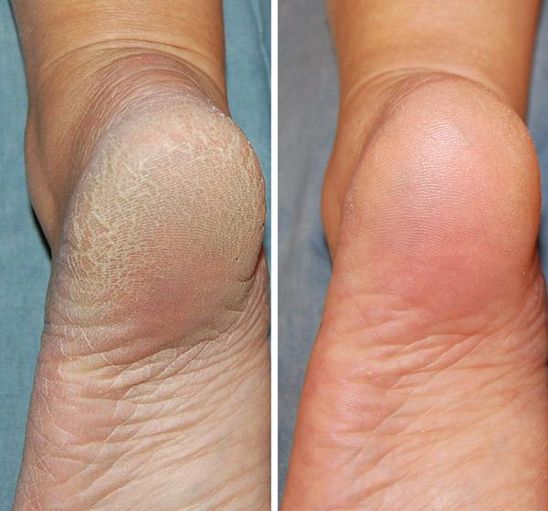 Removedor de Callos Eléctrico - Pies suaves sin pedicura